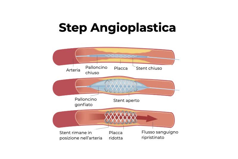 Illustrazione degli step dell'angioplastica